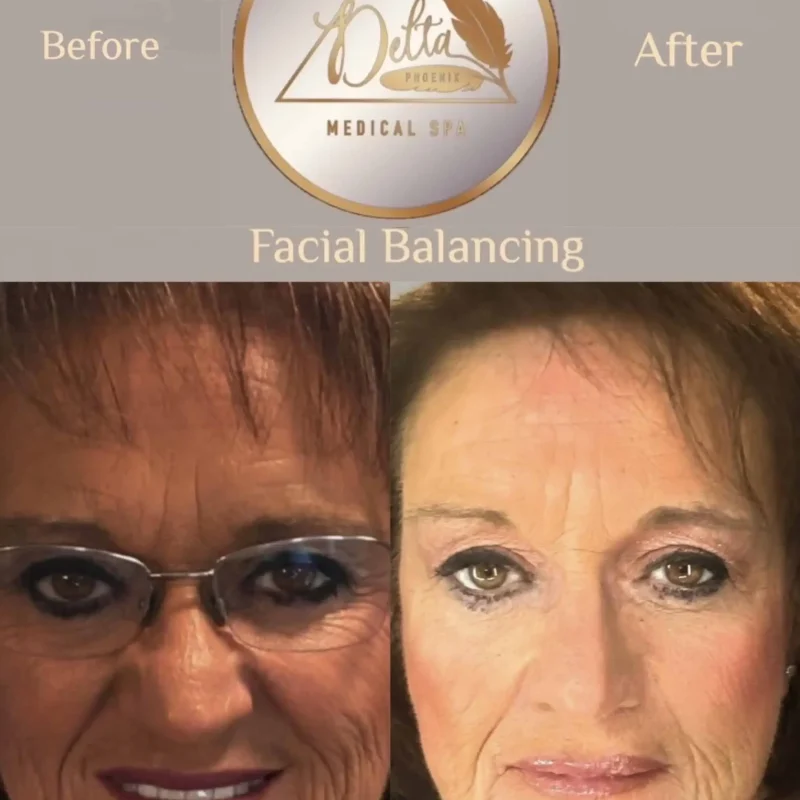 Facial Balancing with filler eight