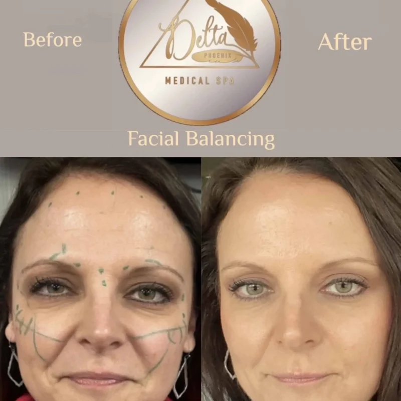 Facial Balancing with filler five