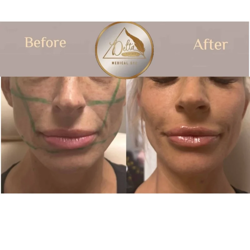 Facial Balancing with filler four