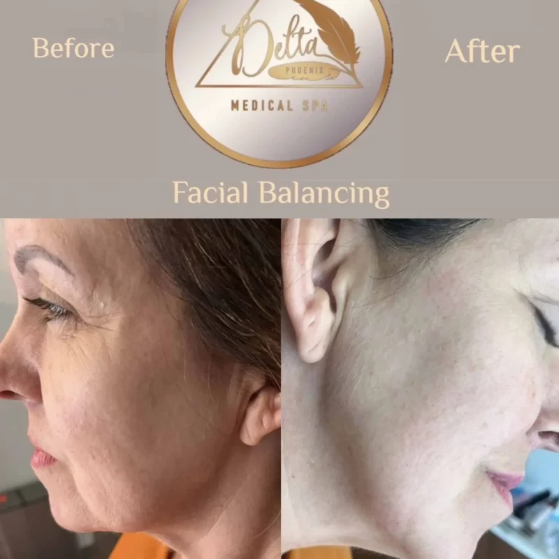 Facial Balancing with filler nine