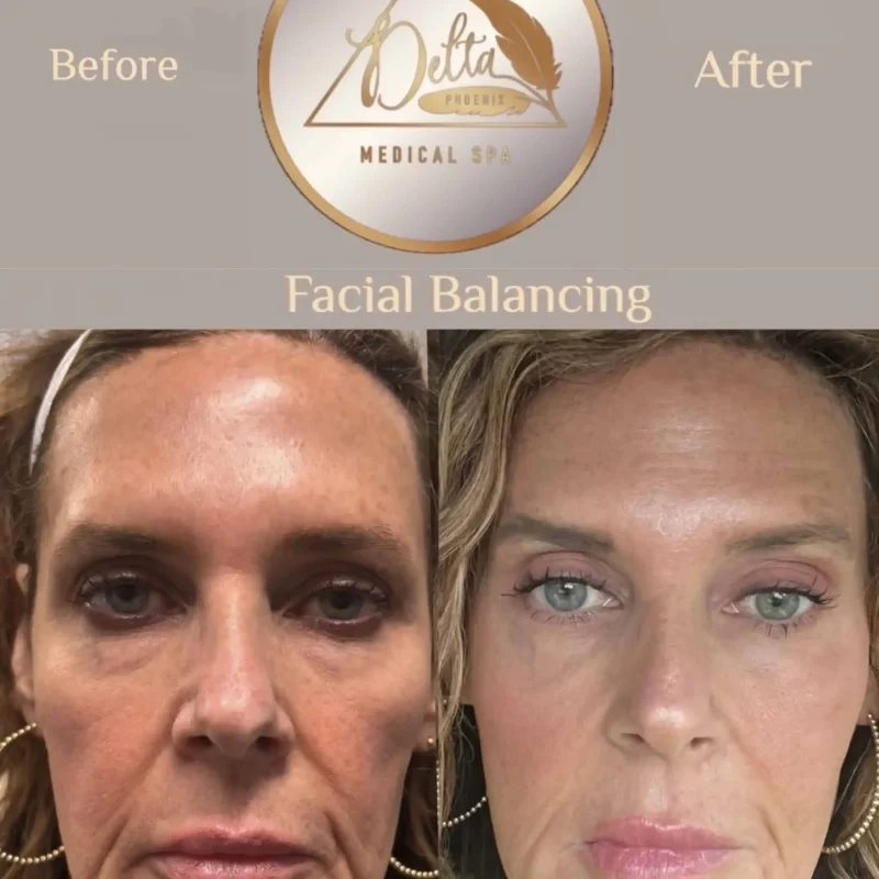 Facial Balancing with filler seven