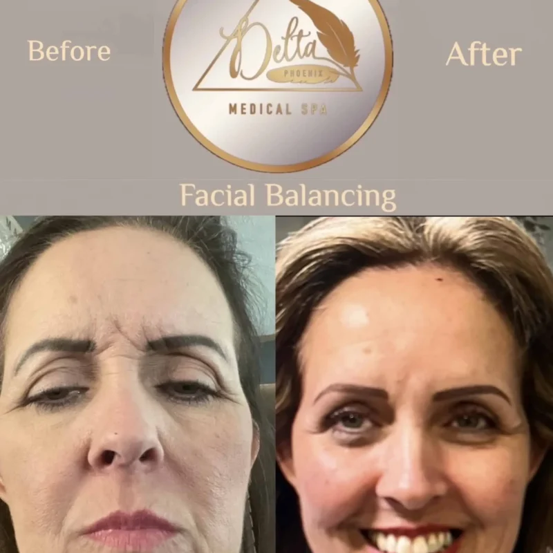 Facial Balancing with filler six