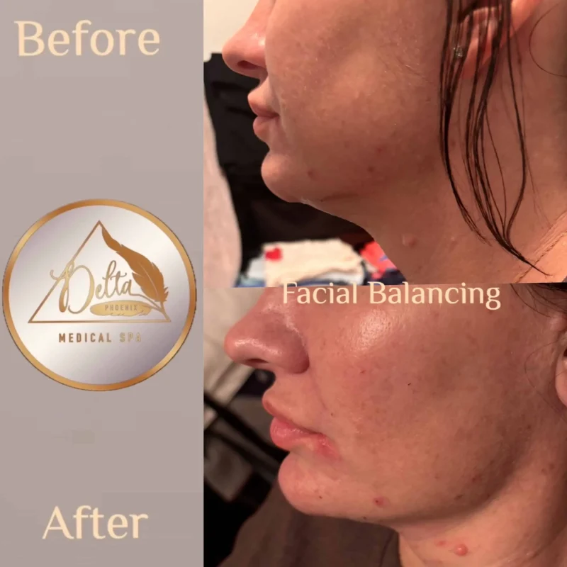 Facial Balancing with filler ten