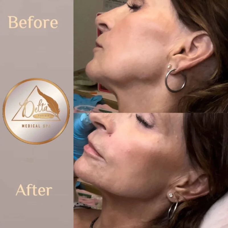 Facial Balancing with filler three