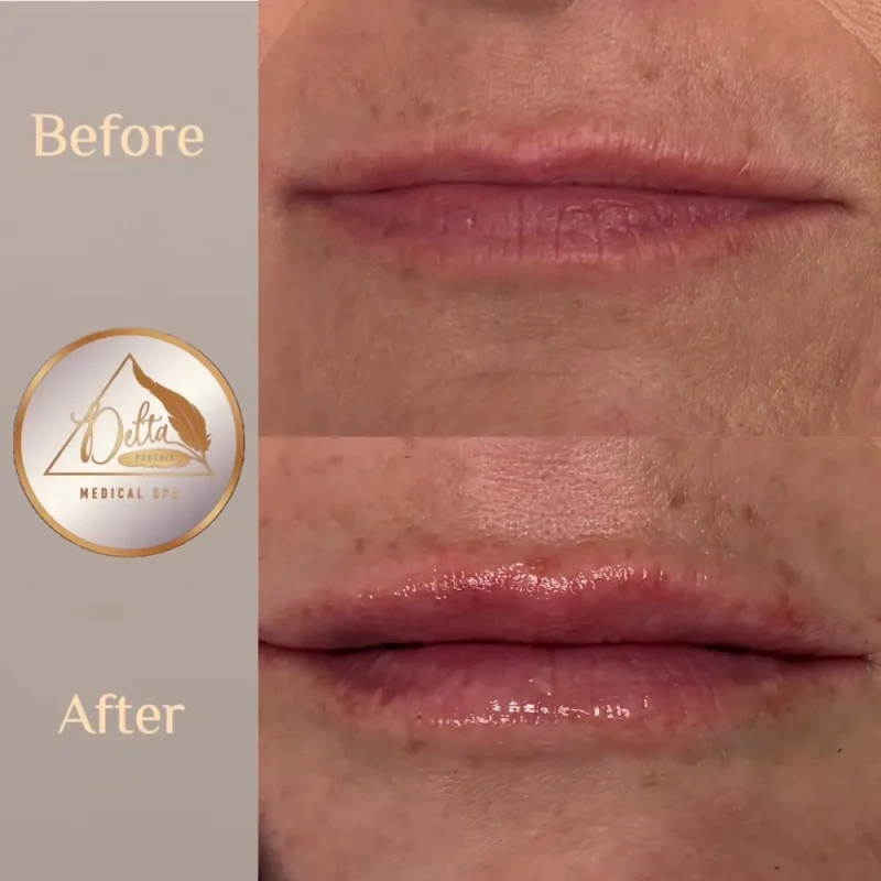 Phoenix-Lips-before-after-a