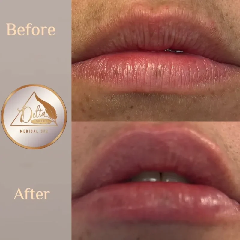 Phoenix-Lips-before-after-b