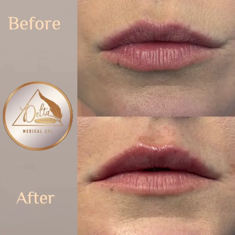 Phoenix-Lips-before-after-c