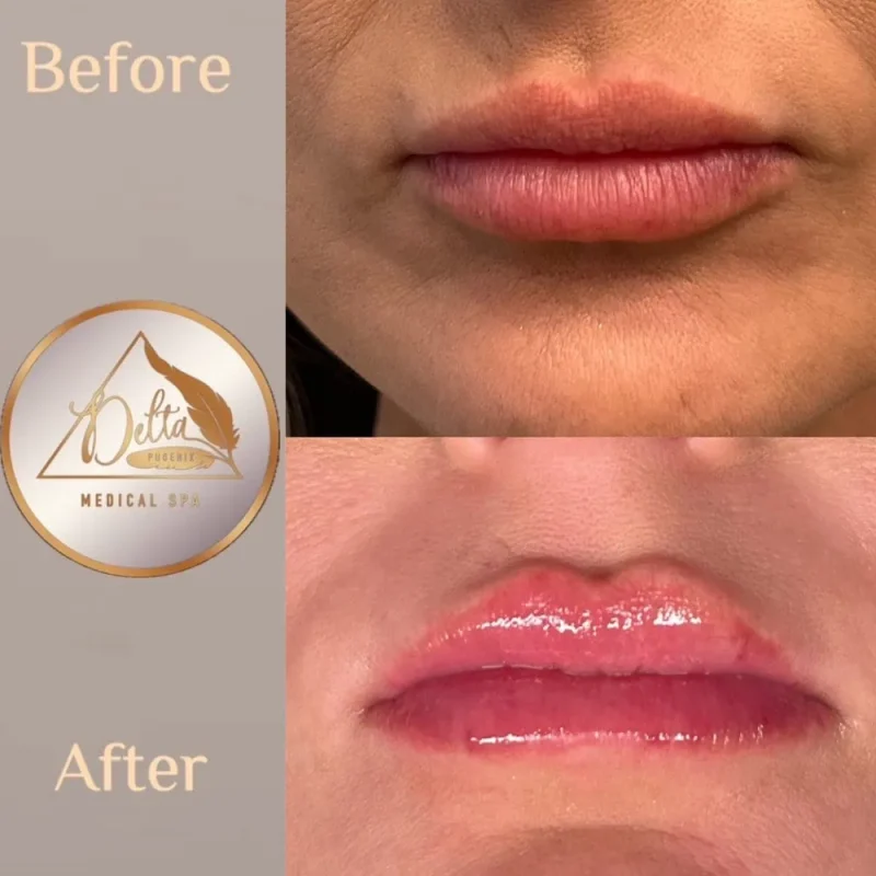 Phoenix-Lips-before-after-d