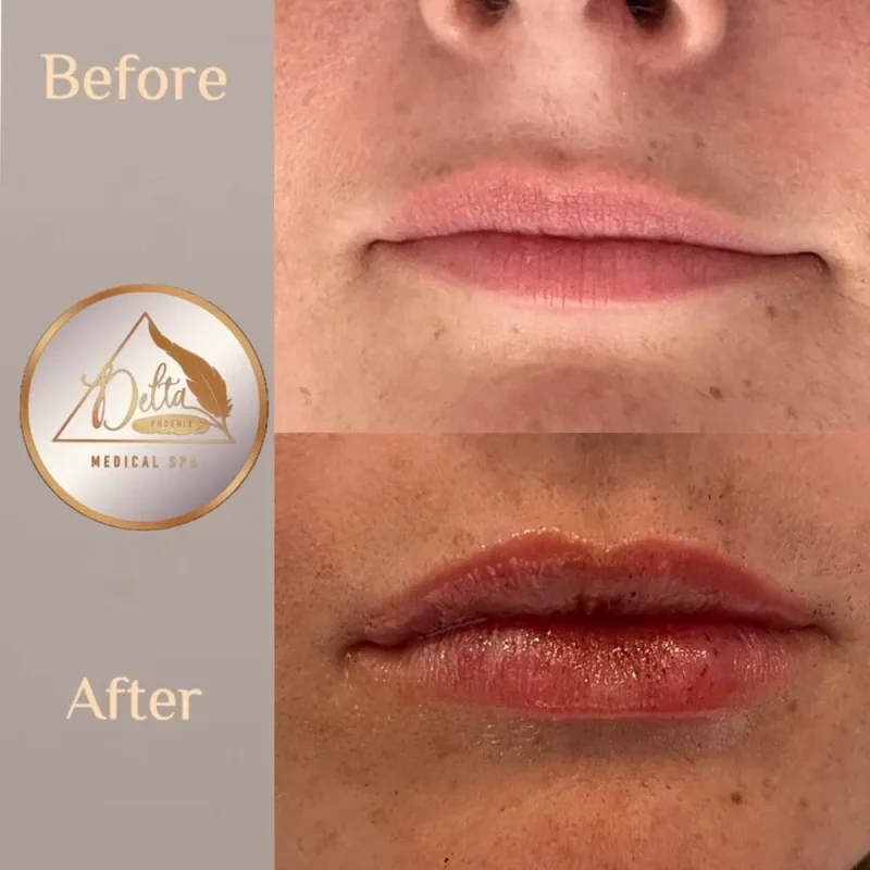 Phoenix-Lips-before-after-e