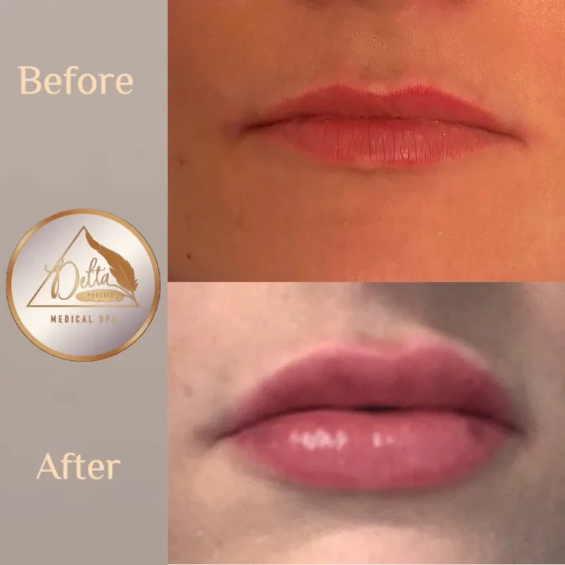 Phoenix-Lips-before-after-f