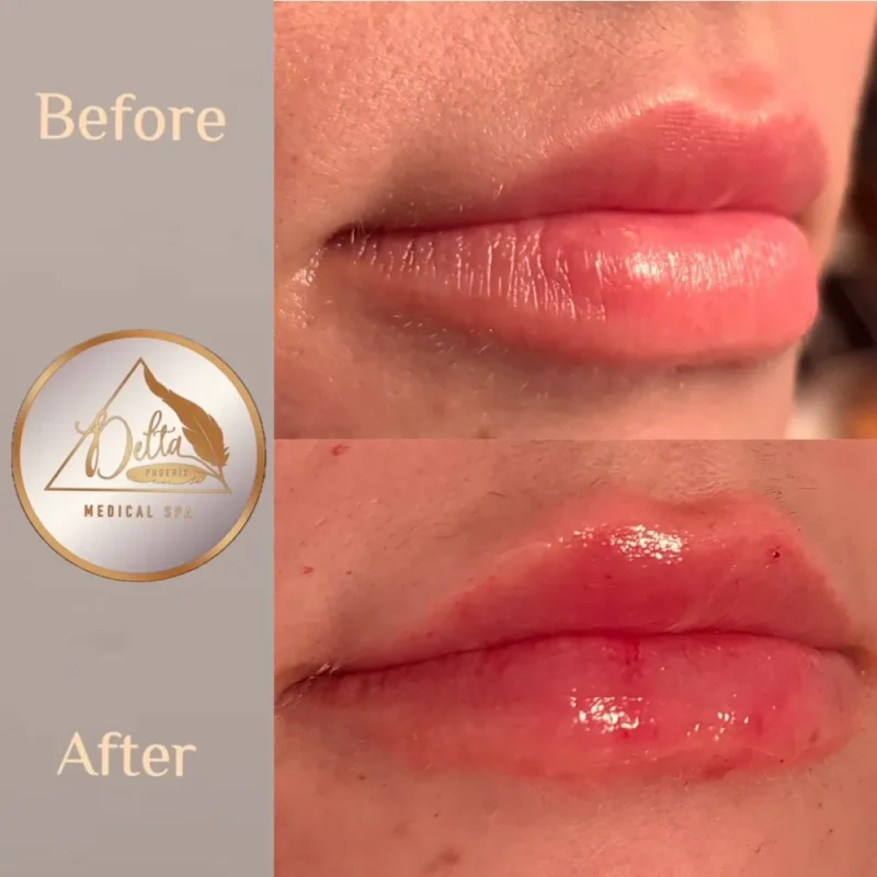 Phoenix-Lips-before-after-g