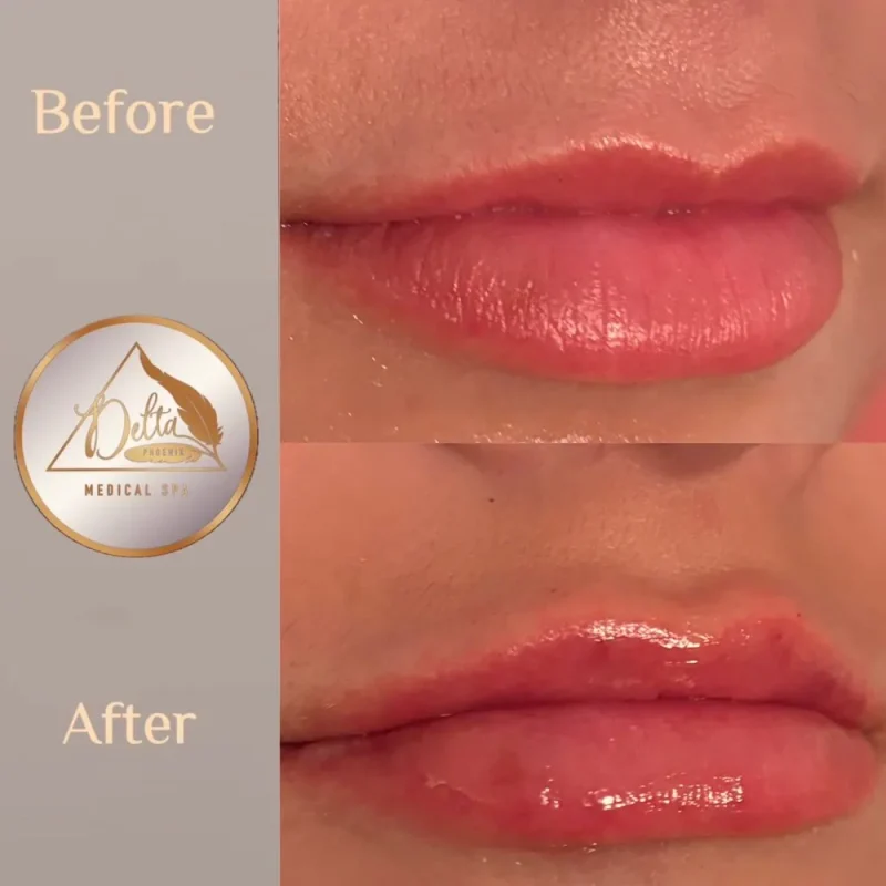 Phoenix-Lips-before-after-h