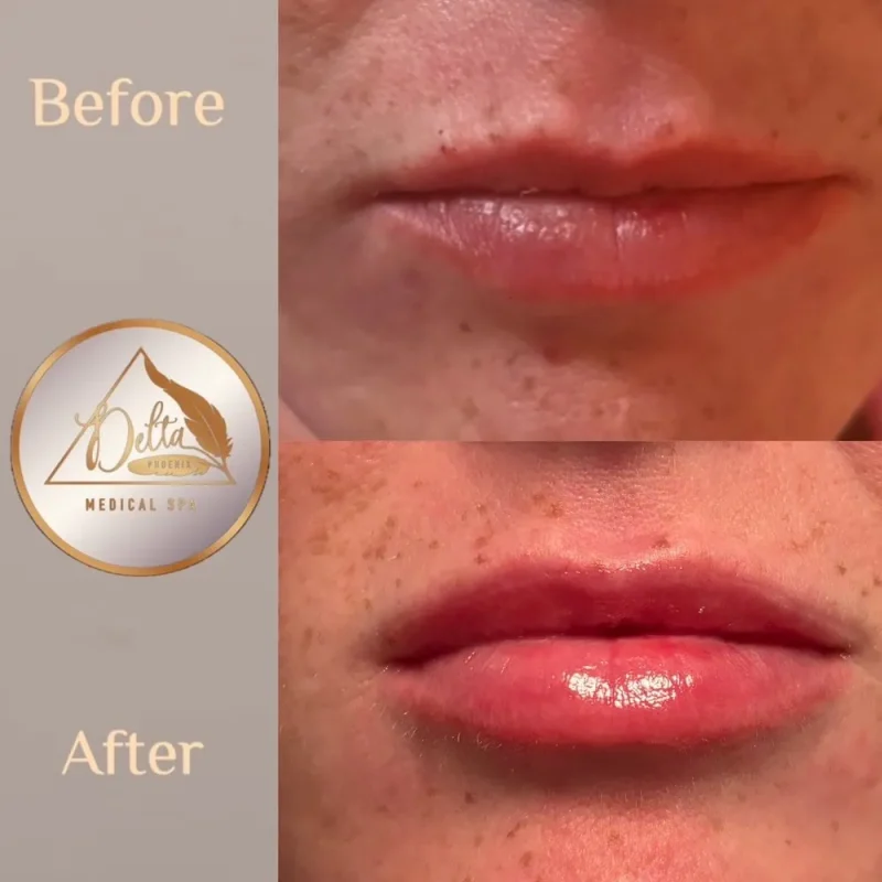 Phoenix-Lips-before-after-i