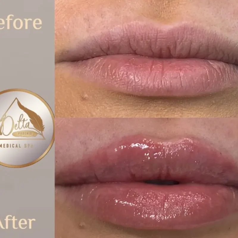 Phoenix-Lips-before-after-j