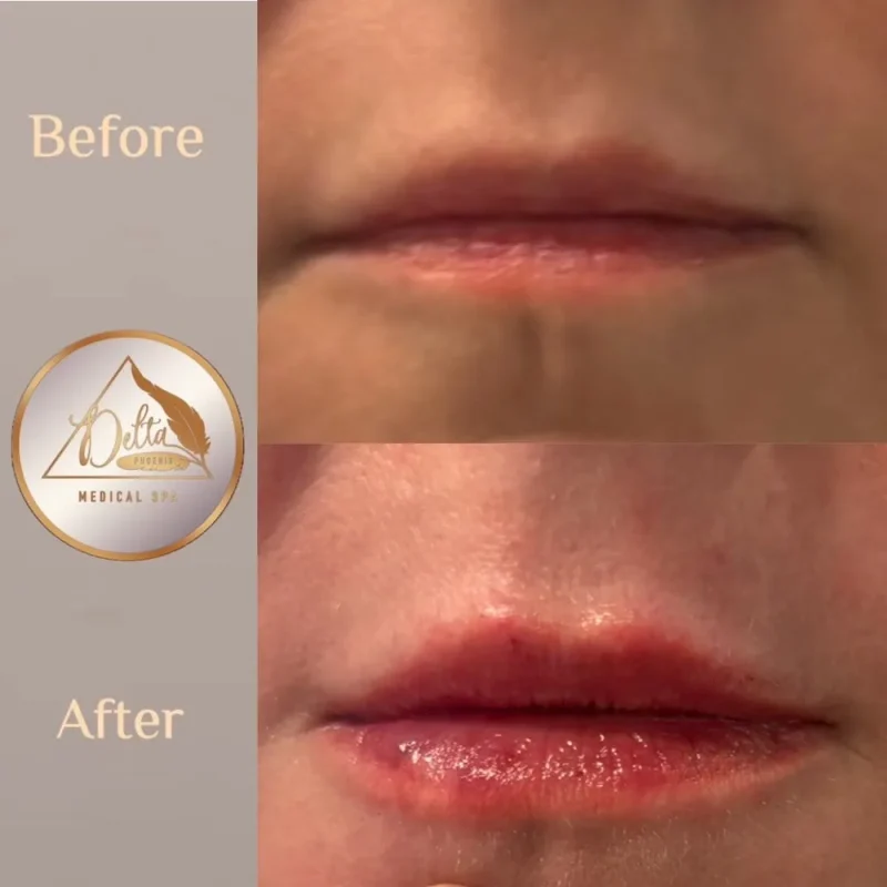 Phoenix-Lips-before-after-m