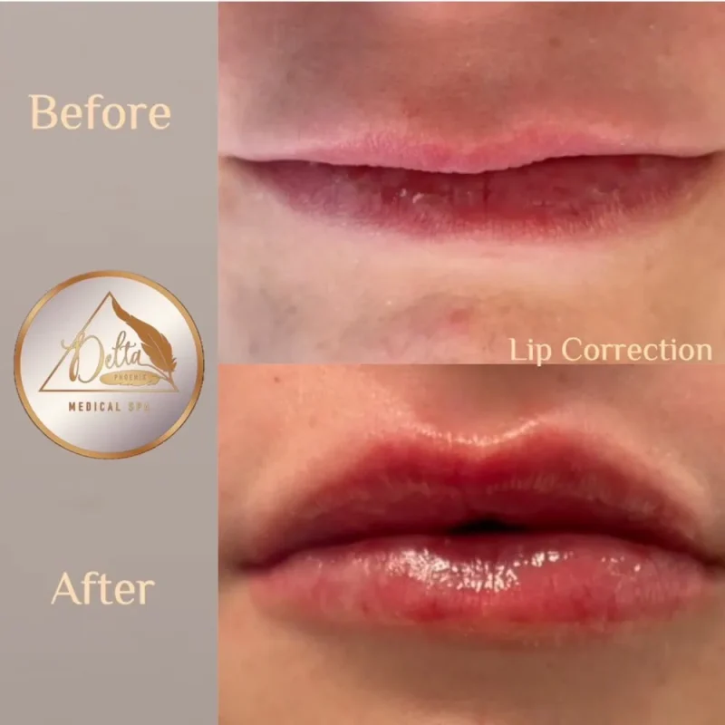 Phoenix-Lips-before-after-n