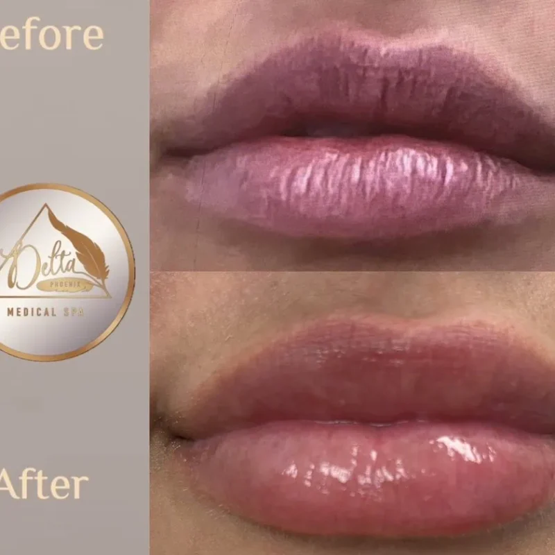 Phoenix-Lips-before-after-o