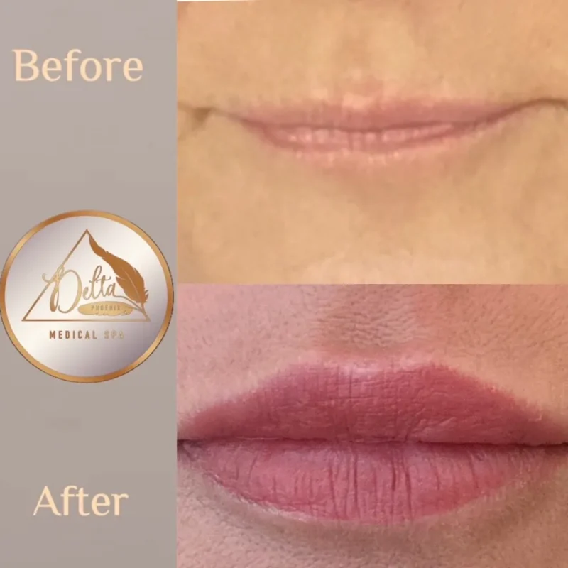 Phoenix-Lips-before-after-p