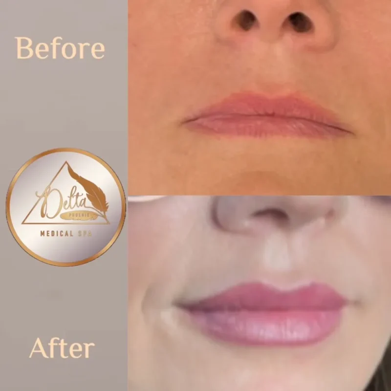 Phoenix-Lips-before-after-q