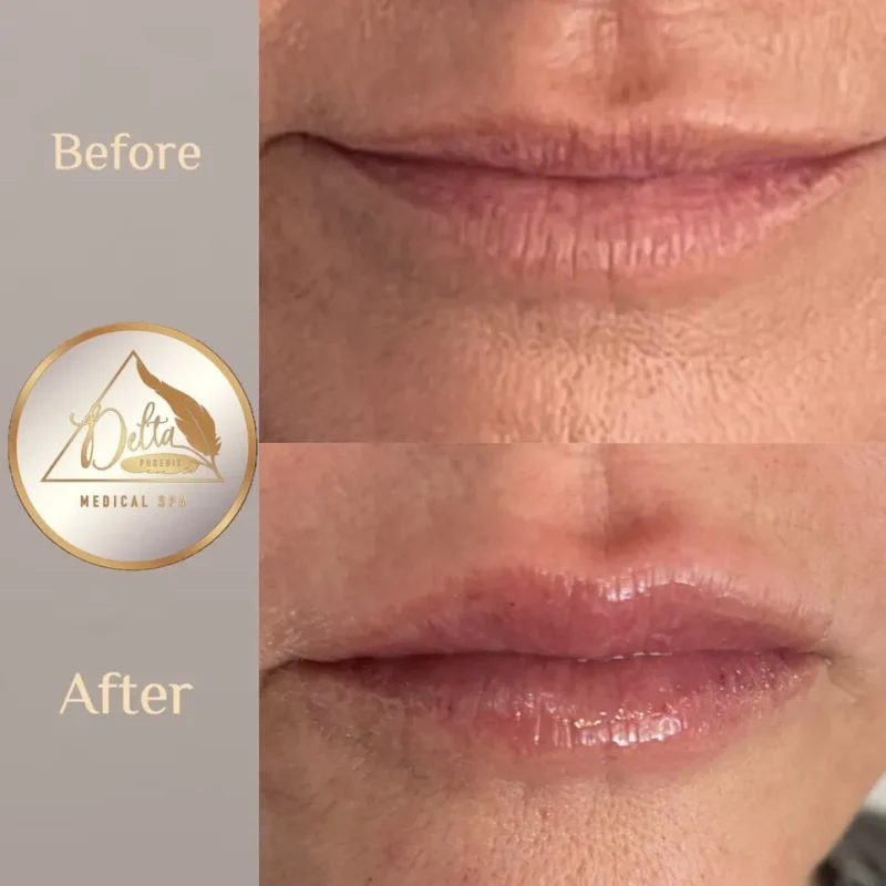 Phoenix-Lips-before-after-s