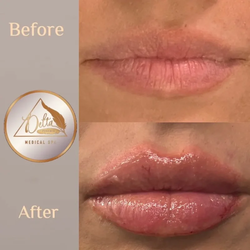 Phoenix-Lips-before-after-t