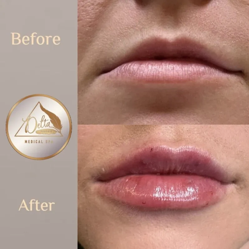 Phoenix-Lips-before-after-u